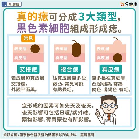 為什麼會長黑痣|是痣？還是皮膚癌？皮膚科醫師教你揪出「假的痣」，。